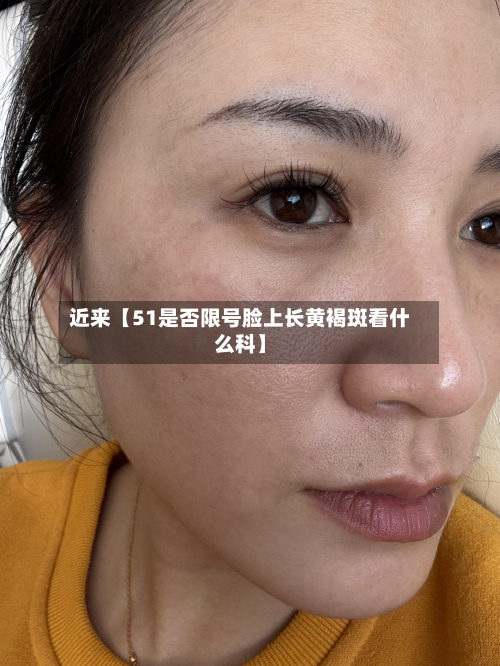 近来【51是否限号脸上长黄褐斑看什么科】